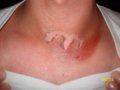Welder_Flash_Burn-300x225.jpg