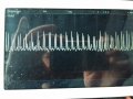 Normal Acceleration Trace.jpg